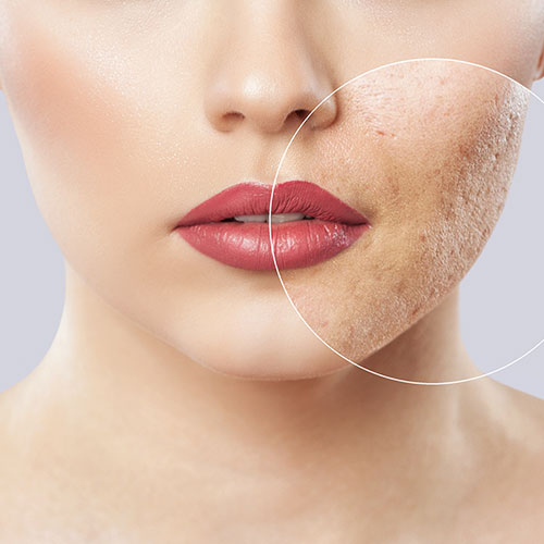 cosméticos veganos acne tratamiento